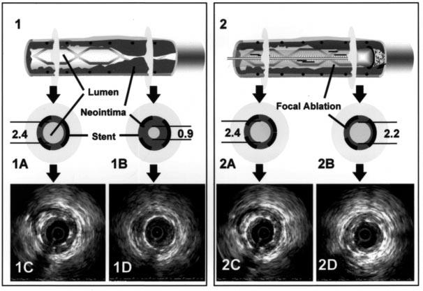 38 Radke et al. JACC Vol. 34, No. 1, 1999 Rotational Atherectomy for Restenosis July 1999:33 9 Figure 2. Relation between in-stent neointima distribution and focal plaque ablation.