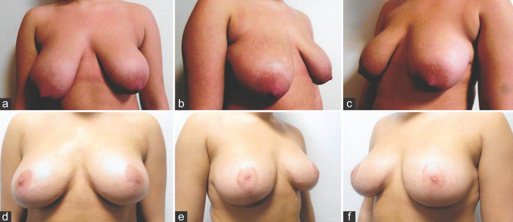 following wise pattern augmentation mastopexy using 225 ml moderate profile textured round cohesive gel silicone implants not more than a cup size and her main concern was the droopy looking breasts