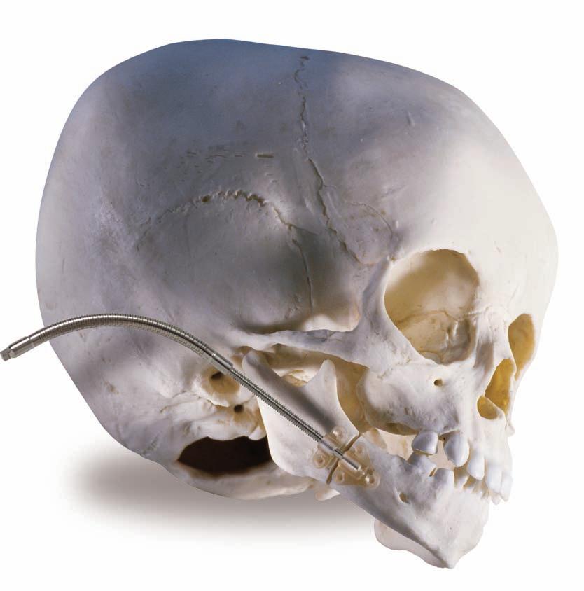 Among our most widely known and used products is LactoSorb SE. First introduced in 1996, The LactoSorb plating system represented a major step forward in craniomaxillofacial fixation.