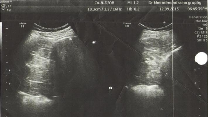 Abdomen and pelvic ultrasound were requested for further examination and a solid mass with the size of 94 67 mm was observed in the right lower lobe of the lung (Figure 2).