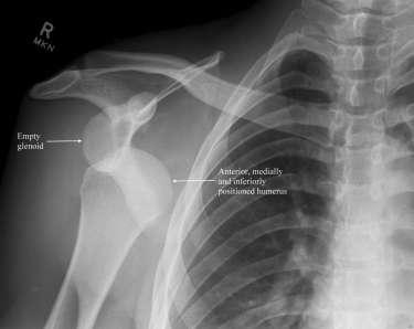 Case 2 18 year old - 3rd anterior dislocation dominant shoulder PS - Always