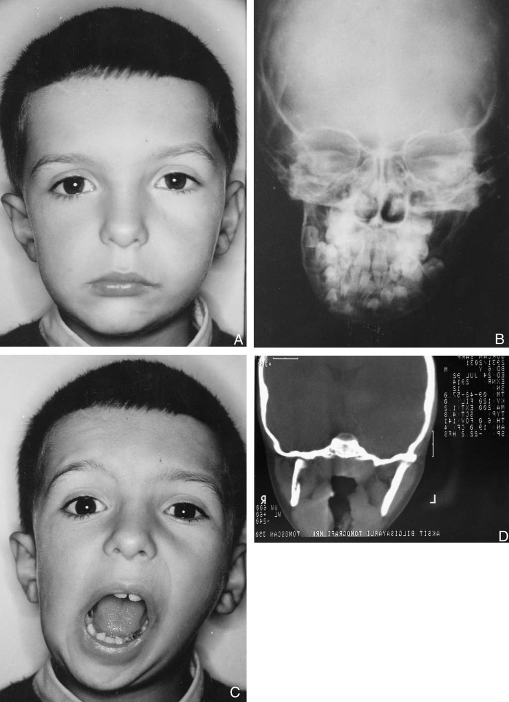 372 ARUN, KAYHAN, KIZILTAN FIGURE 1. Initial clinical photographic (A), radiographic (B), wide-open photographic (C), and tomographic (D) record of the patient.