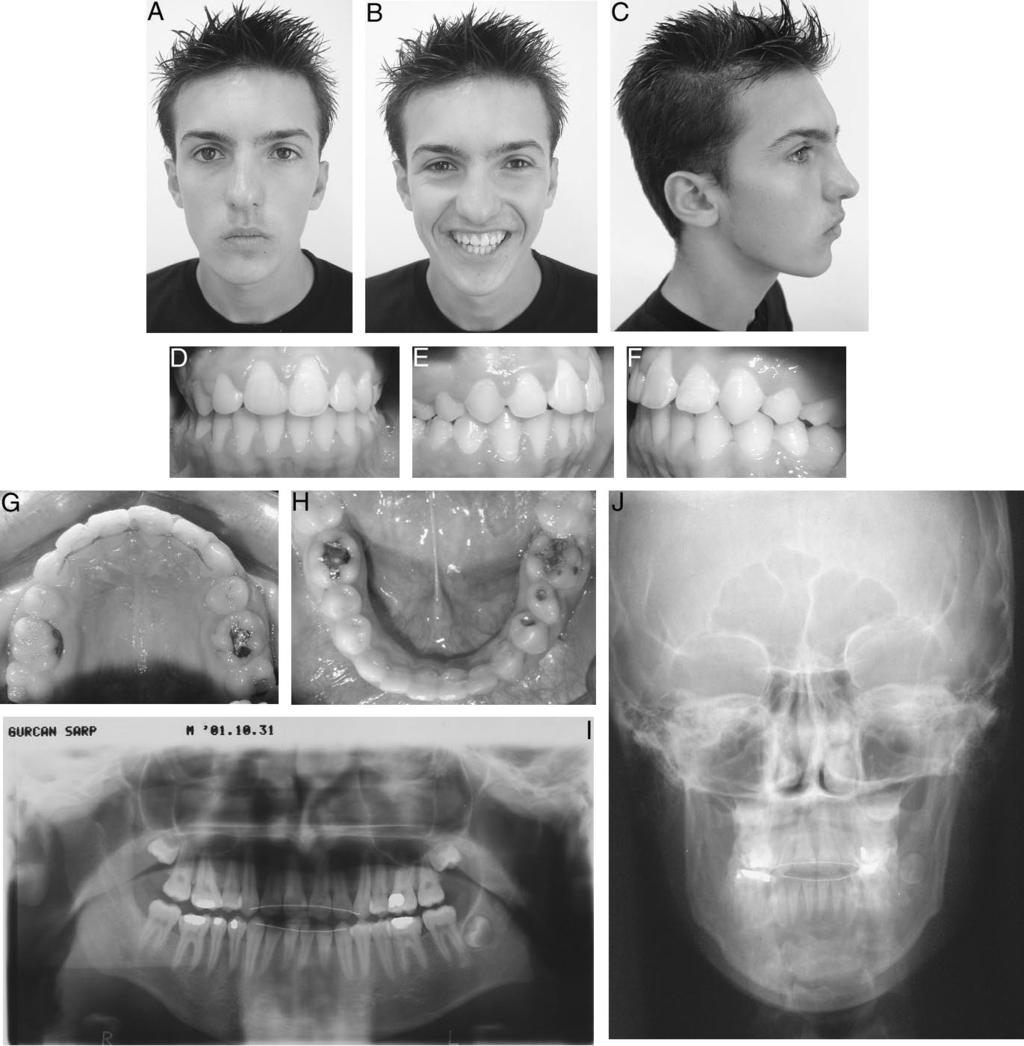 374 ARUN, KAYHAN, KIZILTAN FIGURE 6. (A J) Final extraoral and intraoral and radiographic views of the patient.