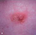 A biopsy revealed urticarial vasculitis ( d), a hypersensitivity response that appears as an exaggerated urticarial reaction that can last for months. The C D lesions respond to dapsone therapy.