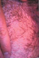 Case 3 Why won t this rash leave? A 44-year-old man complains of a pruritic groin rash of five months s duration.