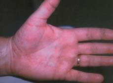 Case 4 What s the cause of this rash? For nine months, a 42-year-old man has had an itchy rash on one hand that features small vesicles on the edges of the fingers and on the palm.