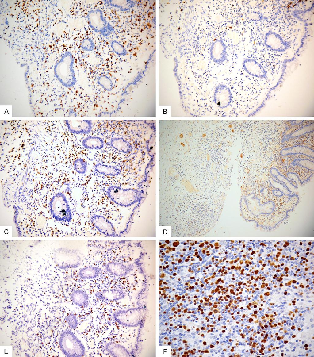 Figure 2. Immunohistochemical features of the case. A. Neoplastic cells in the mucosa are positive for CD3 (original magnification, 200). B.