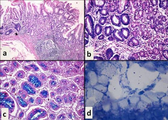 2: (a) Chronic atrophic gastiritis with dysplastic glands H&E x100, (b) Dysplasia with surrounding normal