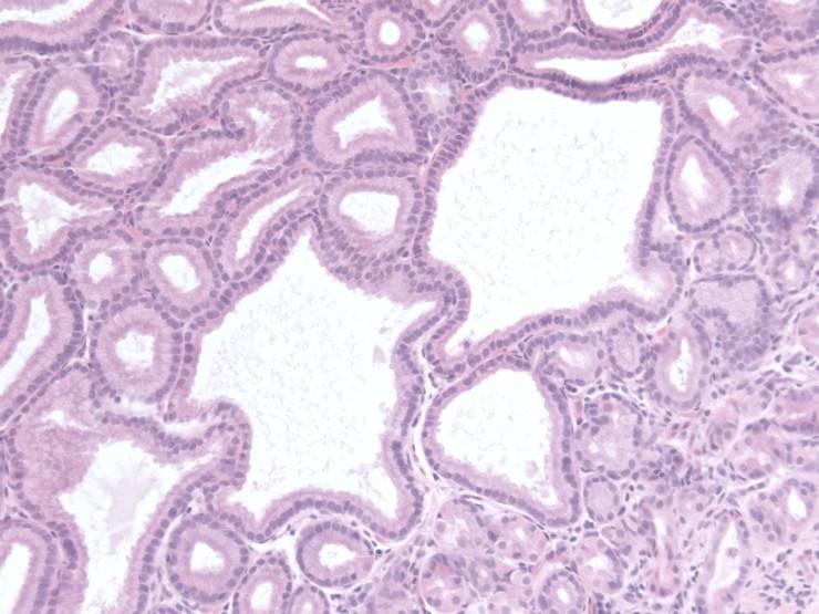 Gastric type 2/foveolar adenoma rarer often large and protuberant lower grades of