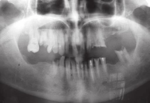 mandible to deprogram the muscles completely. Patient was instructed to wear the occlusal splint for maximum permissible hours per day for 3 months.