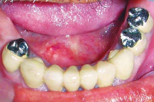 While fabricating porcelain fused to metal restorations rest seats for maxillary and mandibular cast partial dentures were prepared in wax pattern.