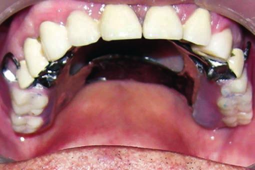 Vaibhav Deorao Kamble Fig. 6A: Post-treatment maxillary occlusal view Fig. 6B: Post-treatment mandibular occlusal view prostheses.