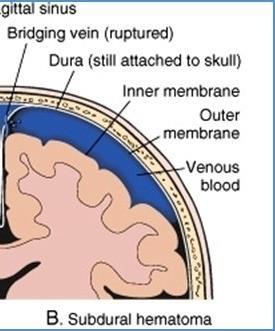 Subdural hemorrhage Results from tearing of the cerebral veins at their point of entrance into the superior sagittal sinus (bridging veins) The cause is usually excessive anteroposterior displacement