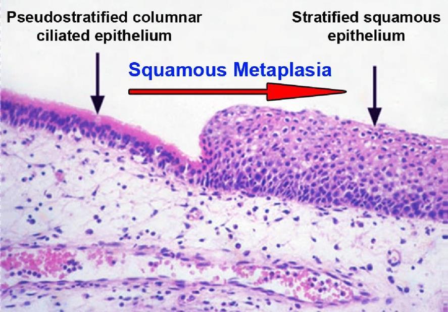 *Not important but might be in pathology questions Squamous metaplasia From pseudostratified columnar ciliates