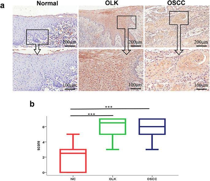 37 can be used as a biomarker for early oral tumorigenesis and for malignant transformation risk assessment of premalignant lesions. (Fig. 2) Fig.