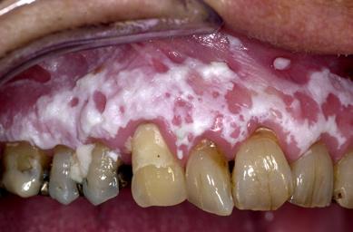However, in case of persistence, it seems safe practice to consider a diagnosis of Candida-associated leukoplakia. -3.