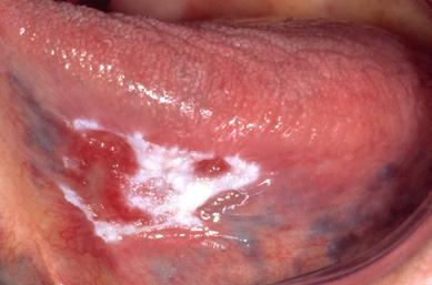 In several of such cases the initial lesion may just be a solitary homogeneous or non-homogeneous leukoplakia (13).