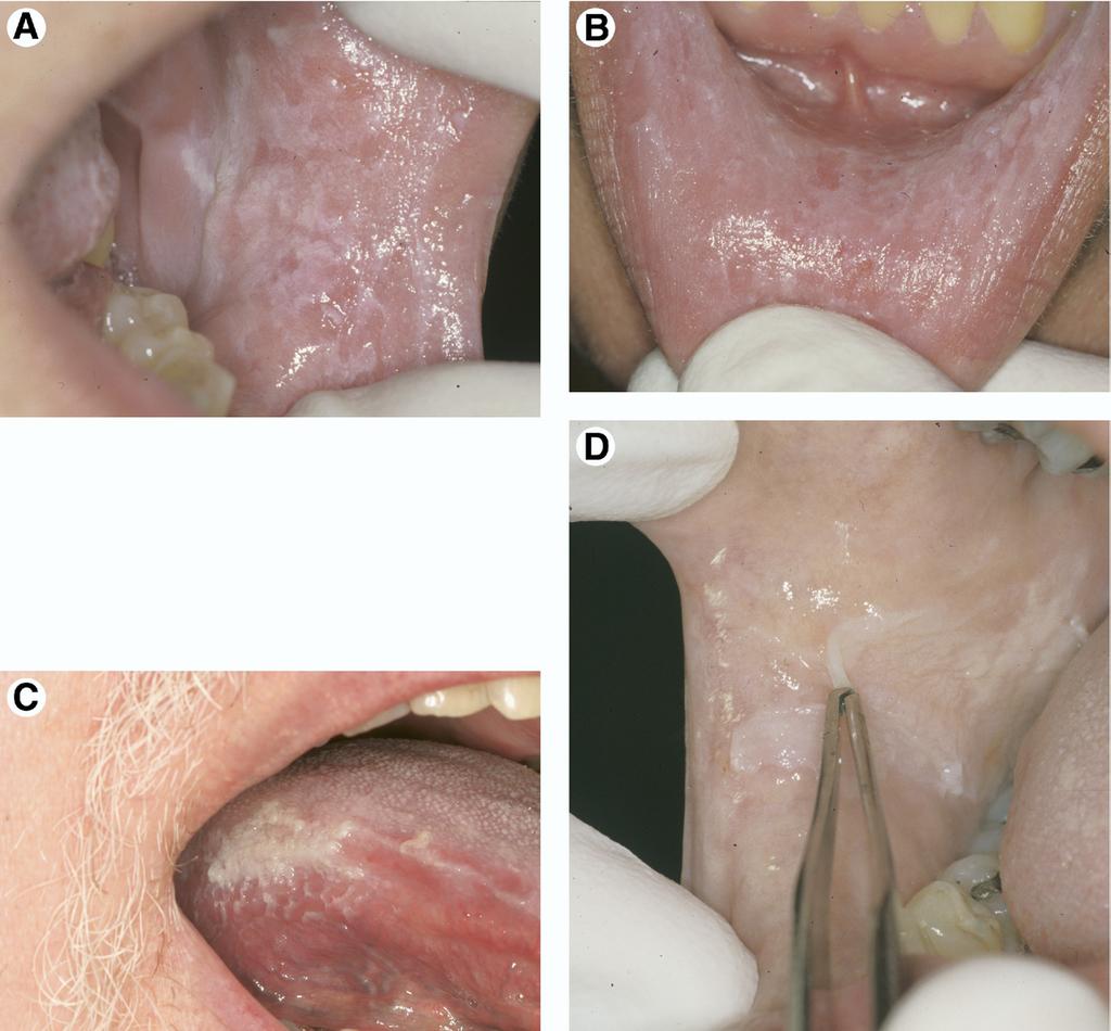 WOO AND LIN 141 FIGURE 1. A, Irregular, shaggy, poorly delineated white papules and plaques of the left buccal mucosa typical for morsicatio mucosae oris.