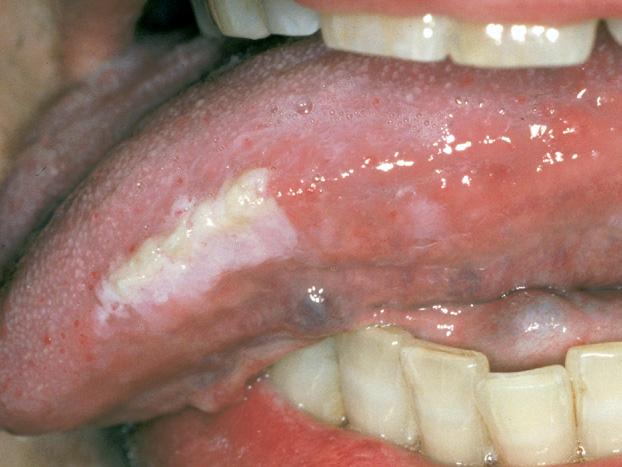 142 MORSICATIO MUCOSAE ORIS 20 Number of cases 15 10 5 0 1 2 3 4 5 6 7 Decade of life FIGURE 2. Leukoplakia-like lesion of left lateral tongue that on biopsy, showed morsicatio mucosae oris.