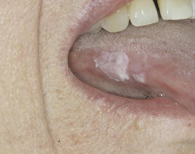 144 MORSICATIO MUCOSAE ORIS tures, namely, hyperorthokeratosis and acanthosis with slight papillomatosis, features identical to friction-induced skin lesions of lichen simplex chronicus.