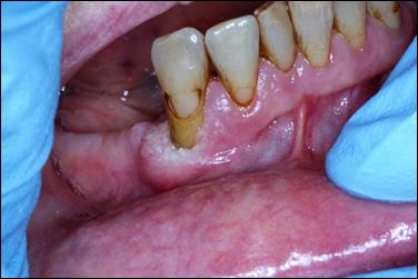 5 Figure 9: Case 2) Proliferative Verrucous leukoplakia PVL on distal, buccal and lingual of #27, Image taken in 2013 Figure 10: Case 2) Complete removal of the lesion along with extraction of #27