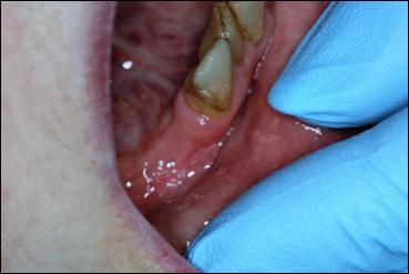 PVL was first defined as a new and different form of leukoplakia by Hansen et al. in 1985 [3-6]. It has been described as an aggressive leukoplakia with rapid malignant transformation.