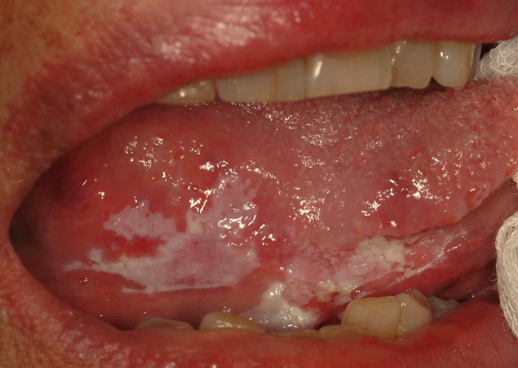 44 The Open Dentistry Journal, 2015, Volume 9 Gissi et al. Fig. (3). A clinically and histologically non-homogeneous OL of the marginal tongue in a 77-year-old non-smoking female patient.