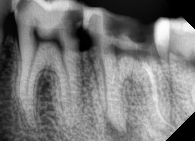 Introduction ABSTRACT The main objective of root canal treatment is thorough mechanical and chemical cleansing of the entire pulp space followed by complete obturation with an inert filling material.
