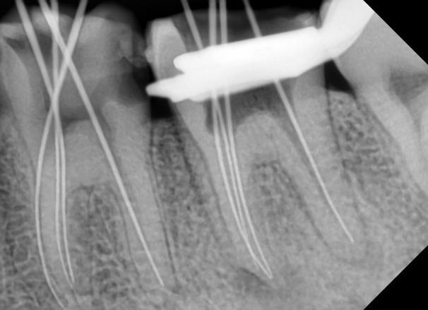 Case I: Fig.2 Case I: Fig.3 The patency of the root canals were obtained using stainless steel no.