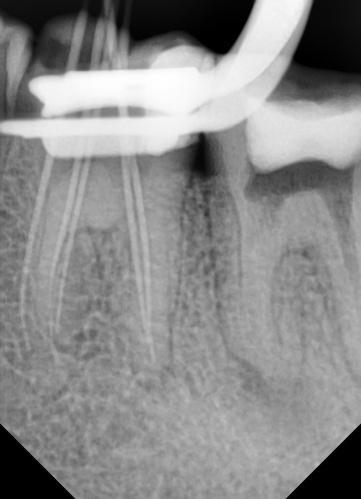 During second appointment, a tiny orifice was detected between the MB and ML with an endodontic explorer DG-16