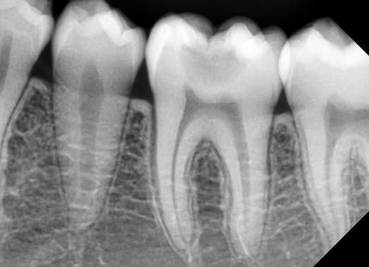Case Report II A 26-yr-old female patient presented to the Rajasthan dental clinic and hospital with a history of severe pain in lower left back region of tooth since 5 days.