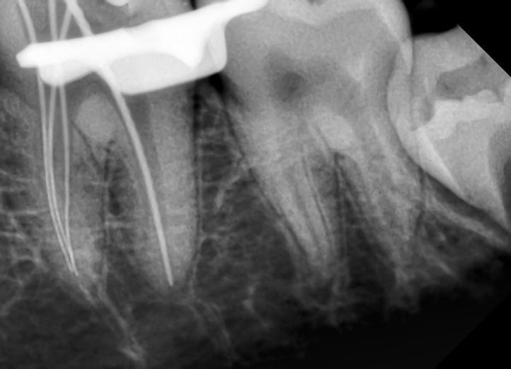 The tooth 36 was tender and there was no swelling / sinus opening present in the adjacent soft tissues. A diagnosis of necrotic pulp with acute apical periodontitis was made.