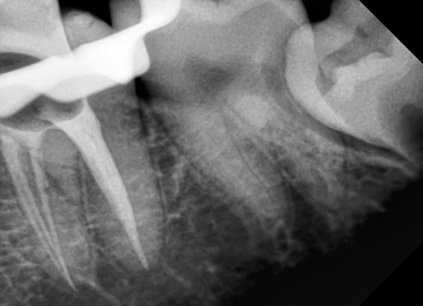 [10] A good pre-operative radiograph is essential for preventing missed anatomy but it does not always necessarily reveal the actual number of canals present in the root.