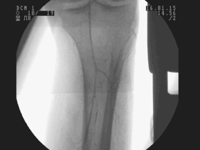 9%) balloon angioplasty of infrapopliteal arteries was performed to establish at least 1 vessel runoff to the foot.