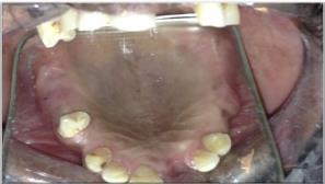 After the temporization of lower posteriors maxillary treatment RPD given in harmony with