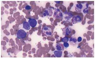 leukaemia/lymphoma with hypodiploidy loss of one or more chromosomes (from 45 to near haploid) children and adults structural abnormality uncommon