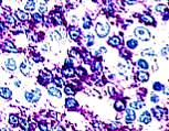 MO LN B B Stem cells +, CD34 + T