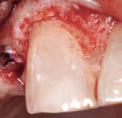 Figs 12a and 12b (left) Insufficient and ragged bone removal seen following the flapless crown lengthening procedure.