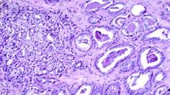 R Slide 33 Grade/Differentiation (6 th digit) Describes how much or little a tumor resembles the normal tissue from which it arose Highly Undifferentiated Moderately Differentiated Prostate