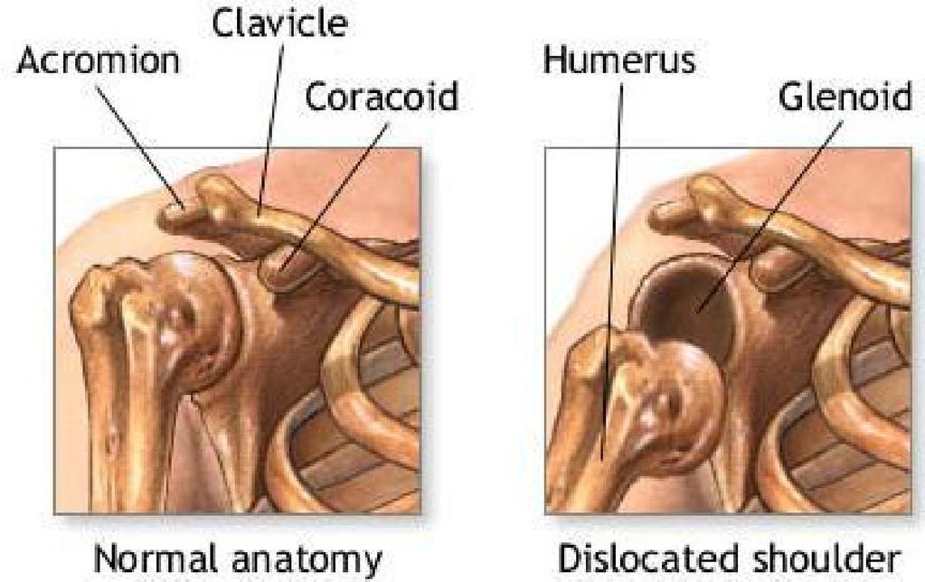 Shoulder Dislocation Explanation A dislocated shoulder occurs when the humerus separates from the scapula at the glenohumeral joint, or in simpler terms, the head of the upper arm bone (humerus) is
