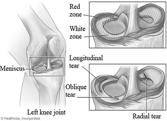 Diagnosis of Torn Meniscus History usually involves trauma Medial or
