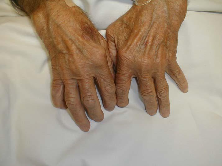 Rheumatoid arthritis Affects