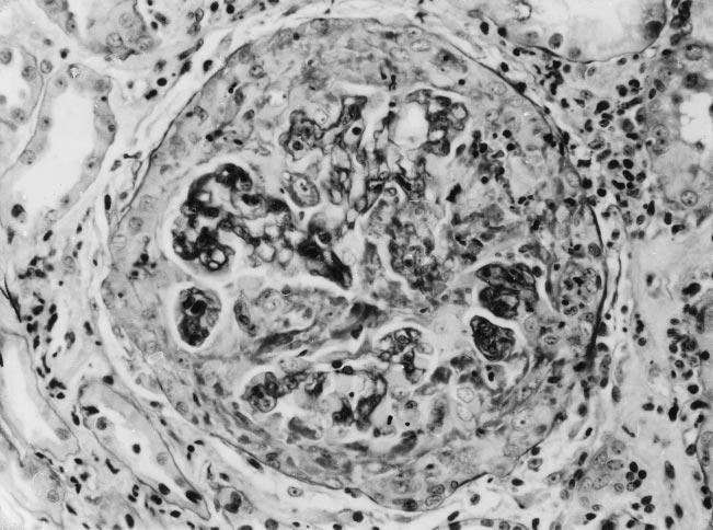 180 HARRIS, FALK, AND JENNETTE Fig 1. Light microscopy showing a circumferential cellular crescent.
