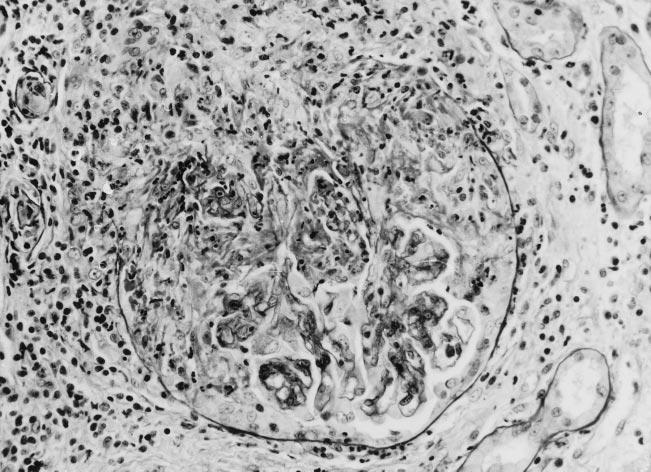 The periglomerular interstitium has slight edema and infiltration by mononuclear leukocytes. (Periodic acid-schiff stain; magnification 500.) munoglobulin G (IgG), IgA, and C3.