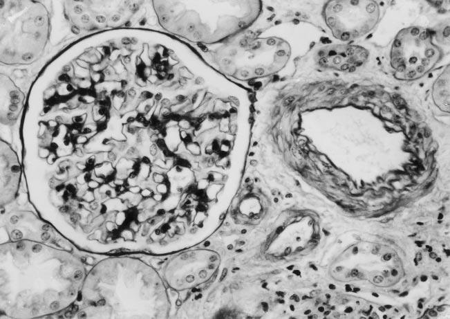 CRESCENTIC GN LACKS GLOMERULAR IG LOCALIZATION 181 Fig 3. Light microscopy showing one of the few glomeruli in the specimen that did not have necrosis or crescent formation.