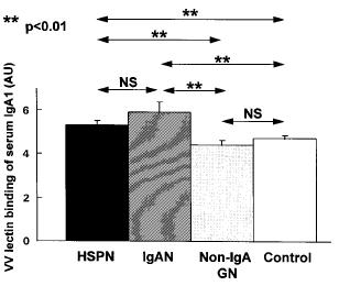 Children with HSP nephritis showed significantly higher IgA1-VV binding than children with HSP lacking renal involvement (P=0.