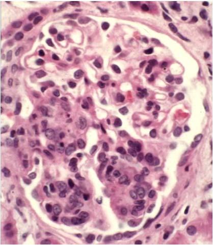 IgA Nephropathy Focal or Diffuse Mesangioprolifertive
