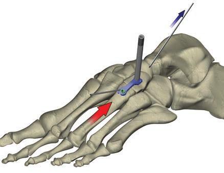 Figure 13 Removing the proximal K-wire Figure 14 Bicortical