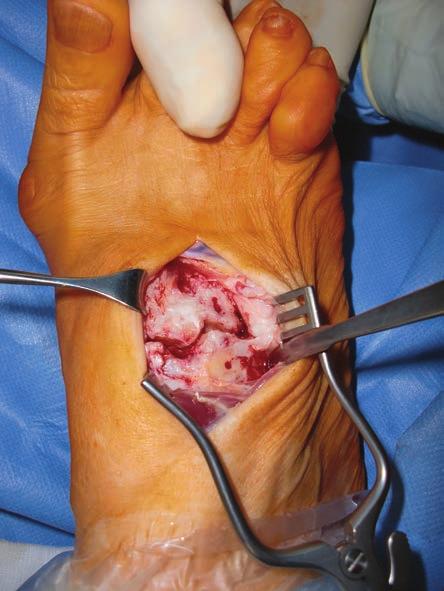 XX Incision Surgeon makes a dorsal incision to gain access to the midfoot, after verification under Flouro/Xray of the desired joint(s) for fusion.