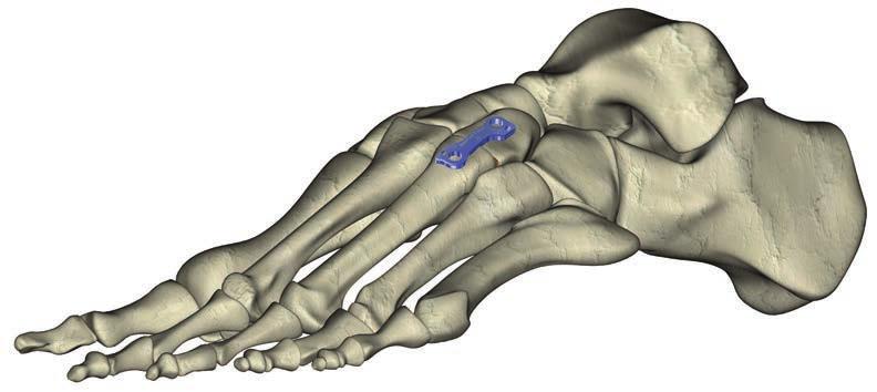 Osteophyte and periarticular bone attachments are removed with